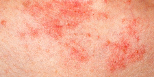 DERMATIT - olika typer av hudinflammationer