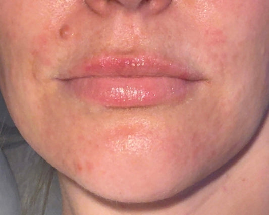 Så läkte jag Perioral Dermatit på en vecka – min personliga hudresa